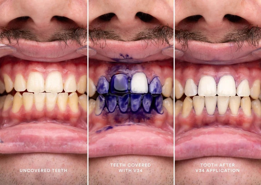 Teeth before, during and after applying the V34 colour corrector